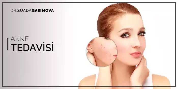 Akne Tedavisi Nedir Suada Gasimova