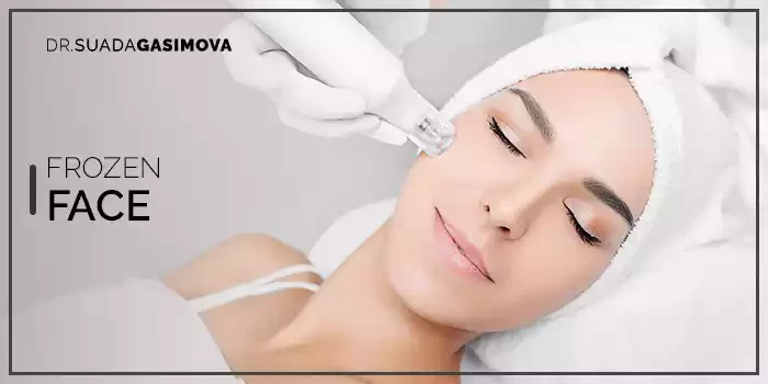 Frozen Face Uygulaması Nedir Suada Gasimova